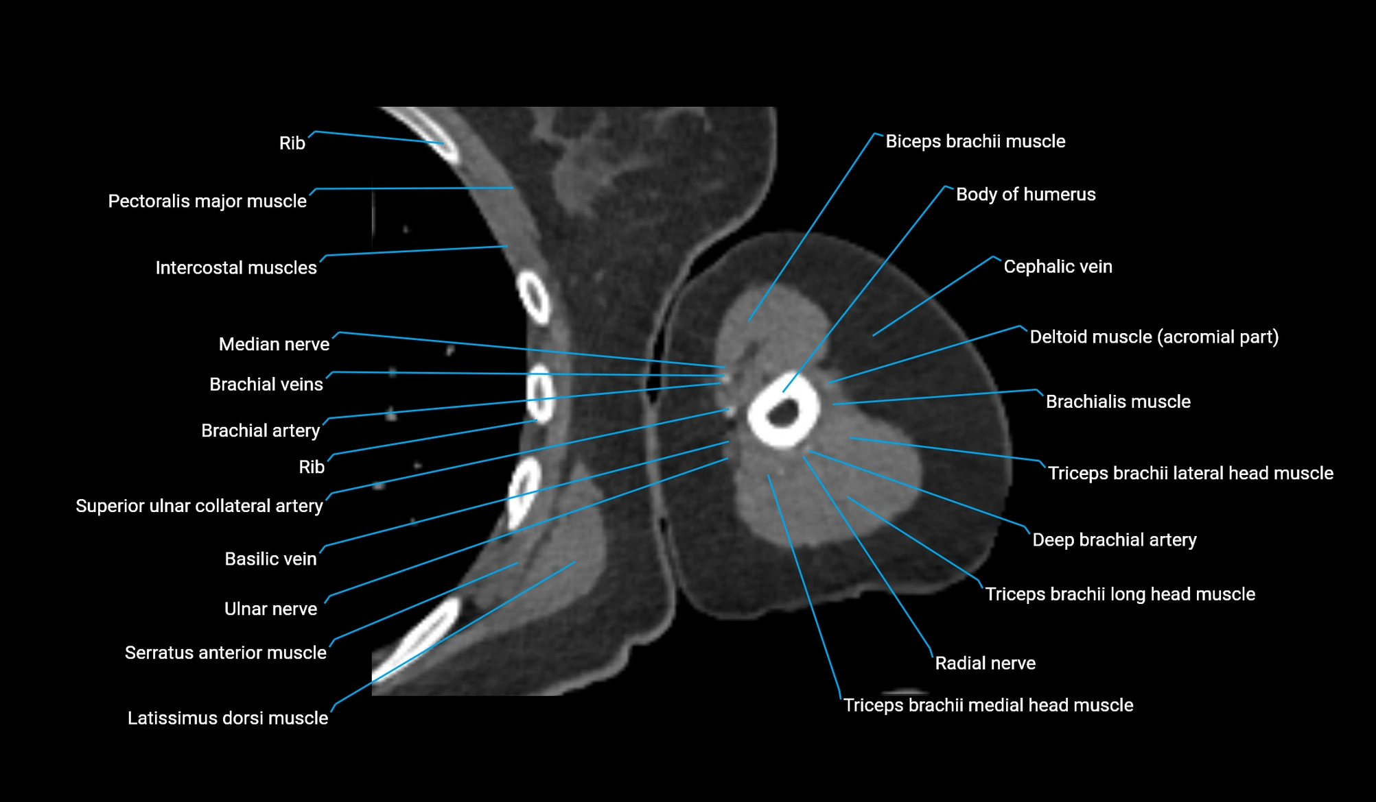 CT upper arm axial  cross sectional anatomy labelled radiology image -00226.webp